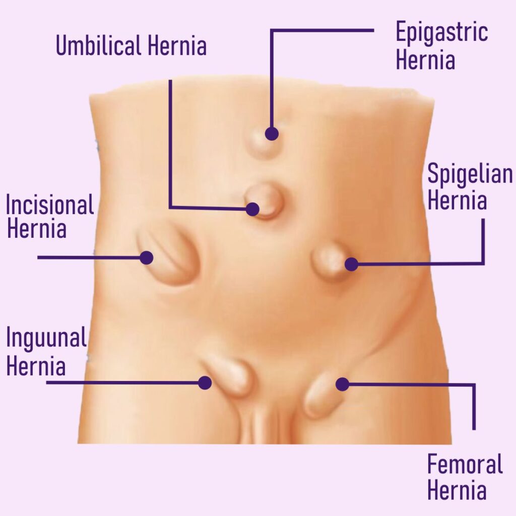 Types of Hernia in Adults